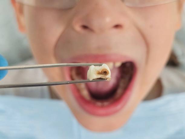 Best Emergency Treatment for Oral Infections in El Centro, CA